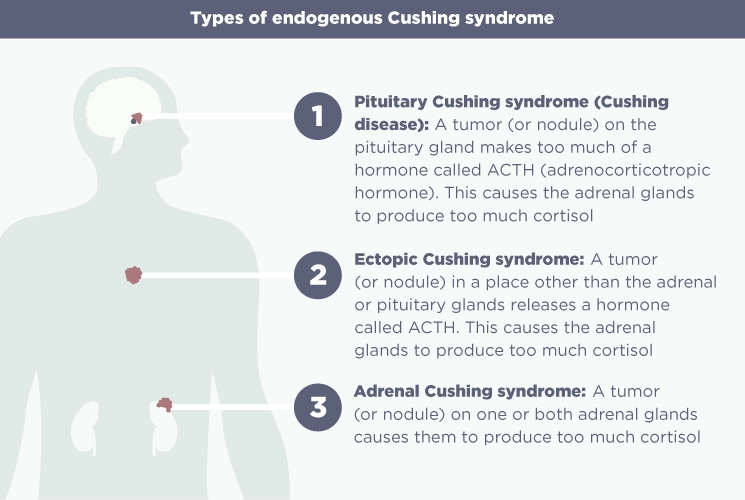 A chart showing the three types of endogenous Cushing syndrome someone can have